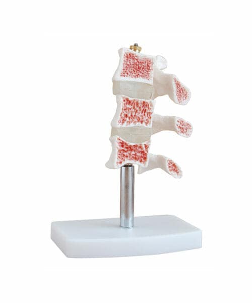 Cutaway Osteoporosis XC-134